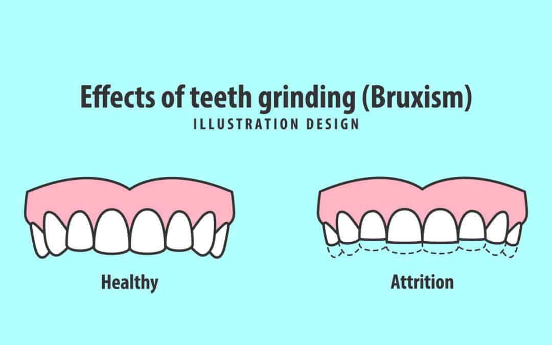 How Teeth Grinding Affects Your Overall Well Being