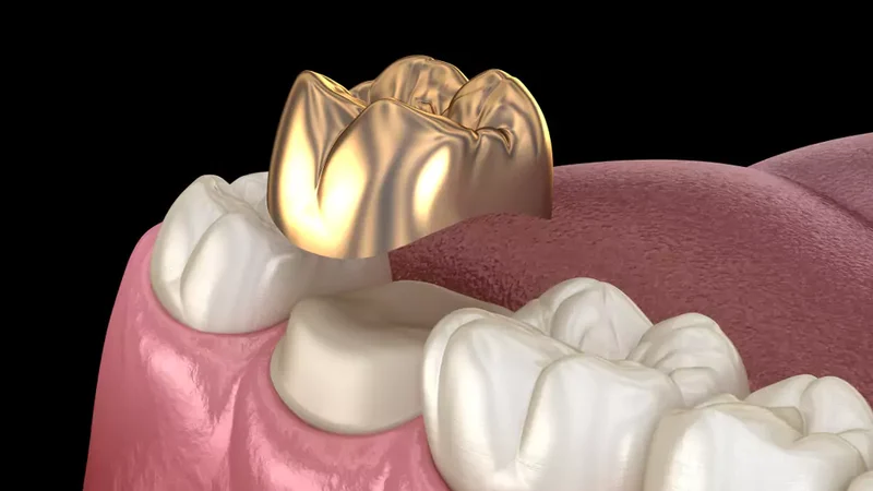 A close look at a gold metal crown installation over a molar tooth of a client for restoration.