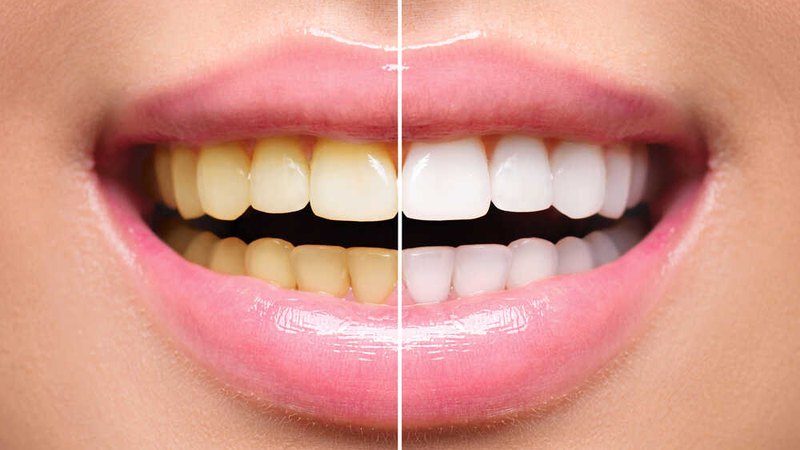 Professional teeth whitening results comparison before and after the procedure at our practice.