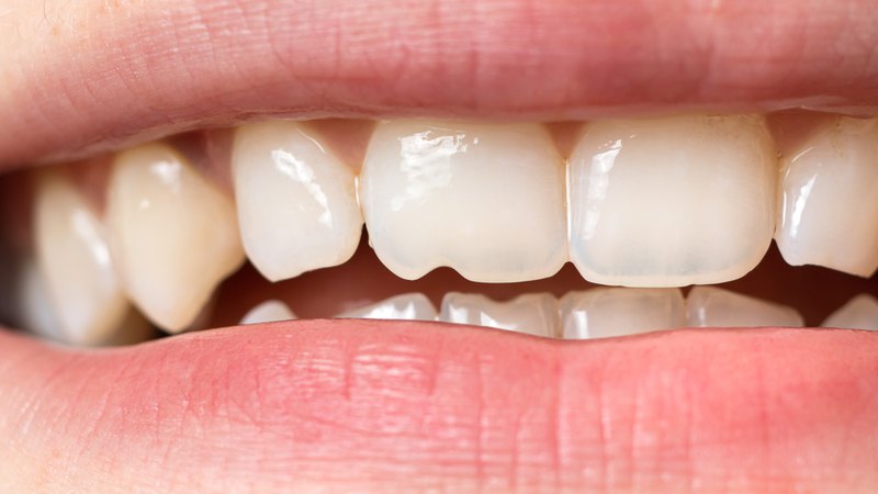 Avoid chewing on hard foods or objects and practice good oral hygiene to save your teeth.