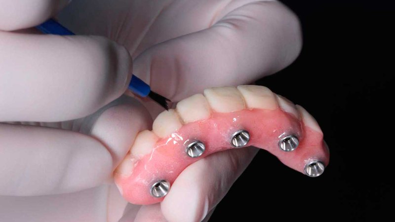 A dentist preparing permanent partial dentures