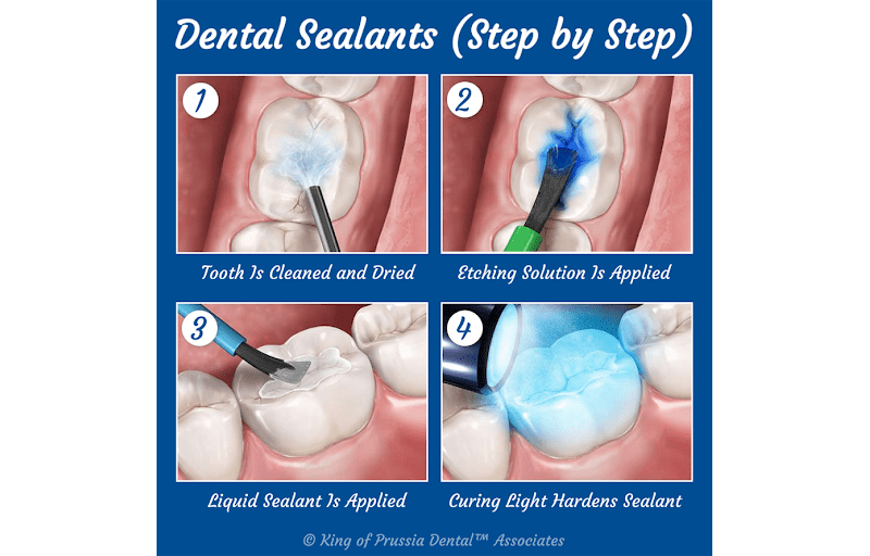 Dental Sealants For Kids King of Prussia Dental™