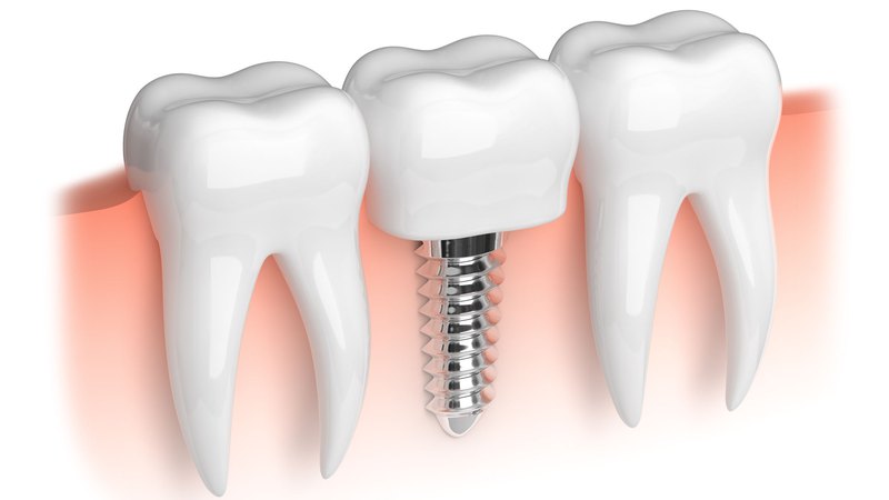 Diagrammatic representation of full dental implants