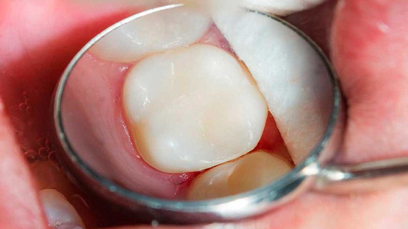 After performing cavity filling, the dentist applies a cosmetic cap to restore your tooth look.