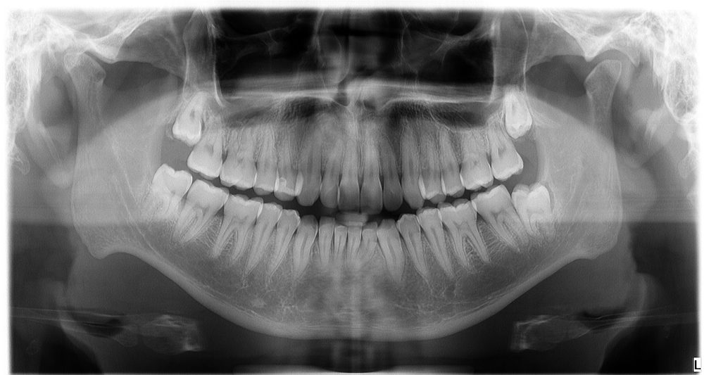 Dental Panoramic XRay Services In King Of Prussia, PA