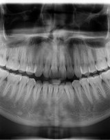 Panoramic Dental X-Ray