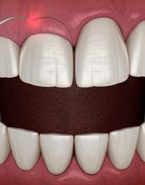 Dental Contouring