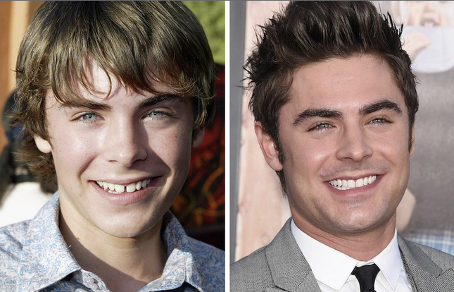 zac efron teeth before and after