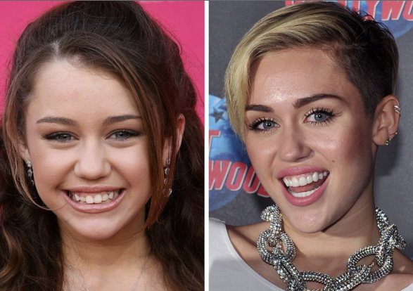  Miley Cyrus teeth before after