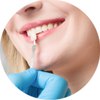 Veneers